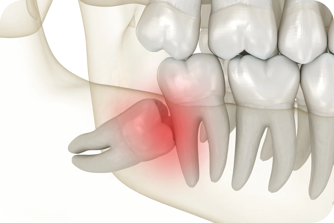 Dents de sagesse