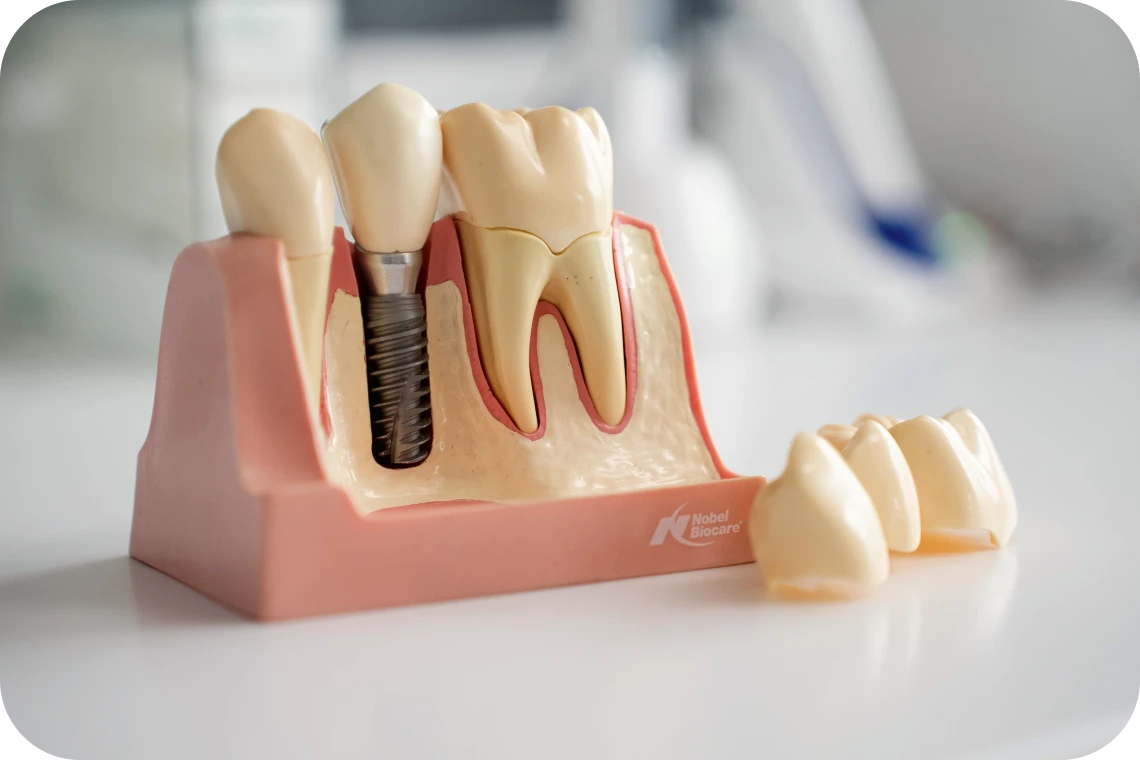 Implant unitaire