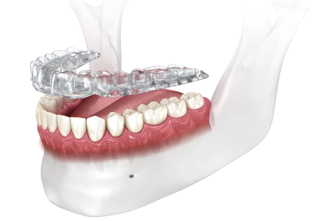 Rééquilibrage occlusal